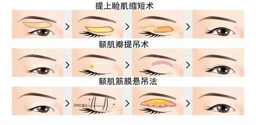 上睑下垂.jpg