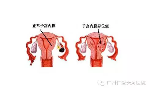 女性五症状，可能导致不孕