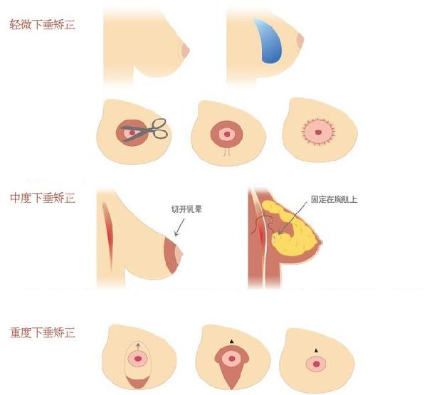 乳房塑形懸吊法通過懸吊下垂的乳腺的組織並改變乳頭及乳暈的原位