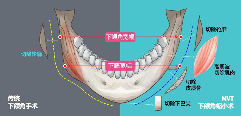 两下颌角间距接近或大于两颧突间宽度2,单侧或双侧下颌角突出,两侧不