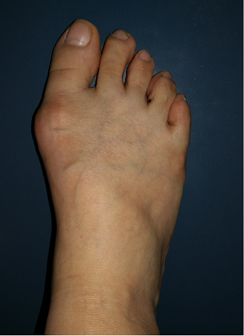 美丽的代价拇外翻