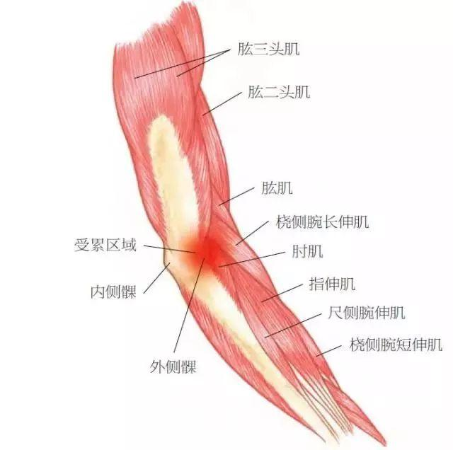 肱骨外上髁炎.png
