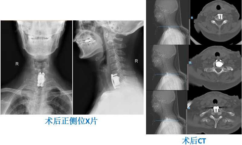 戴慧英术后.jpg