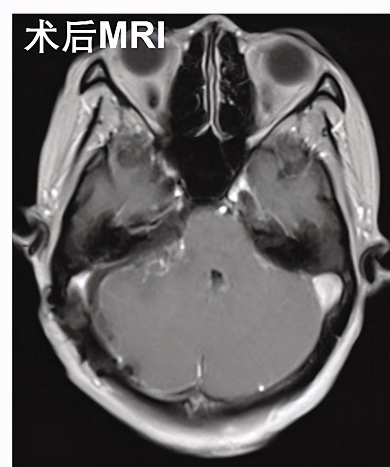 28岁男子听力下降伴耳鸣2年，得了肿瘤？有类似症状的人要注意
