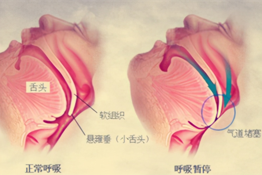 夜间打呼噜早上疲倦？小心！你可能有睡眠呼吸暂停综合征，可致死