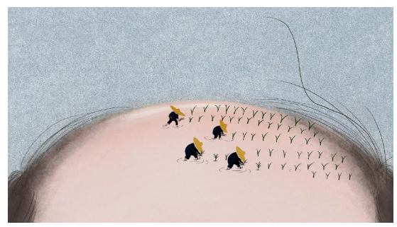 我拿什么拯救“你”，发际线