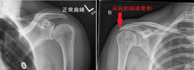 无骨刺.jpg