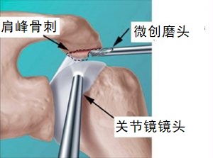 关节镜手术.jpg