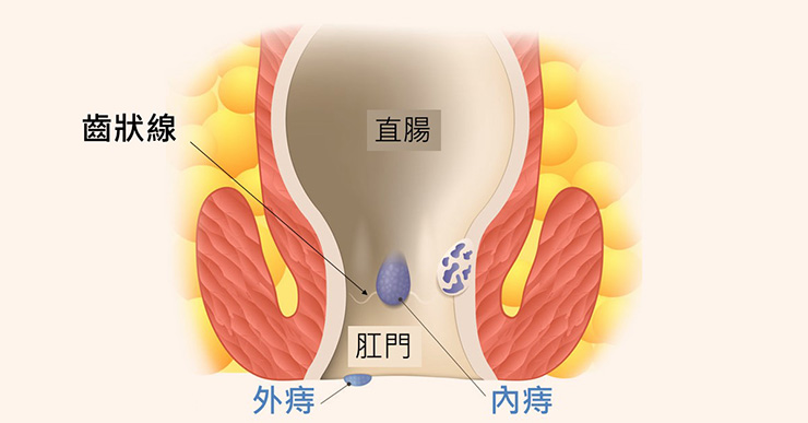 Hemorrhoids21.jpeg