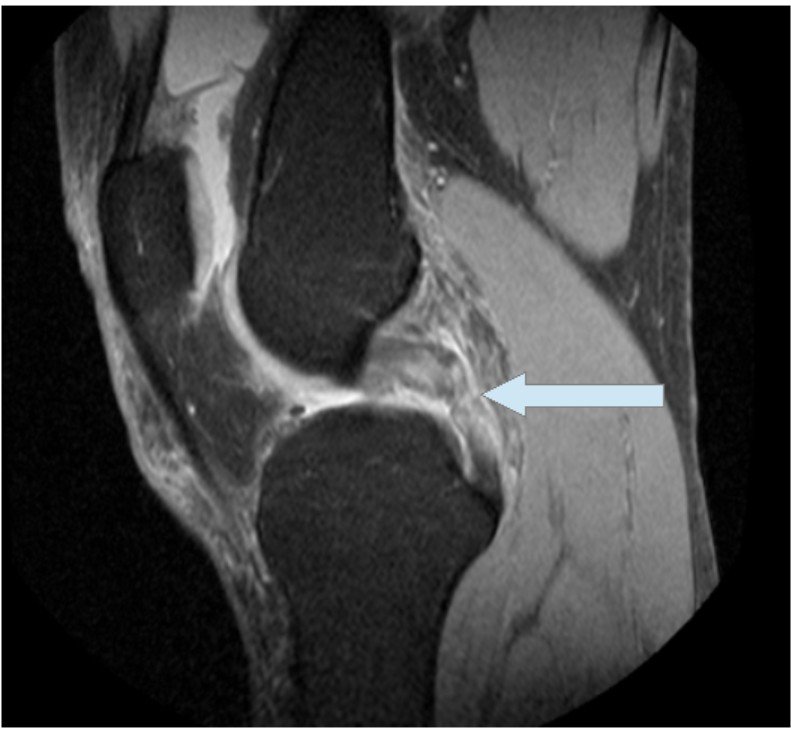 PCL MRI.jpg