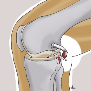 PCL INSERTION.jpg