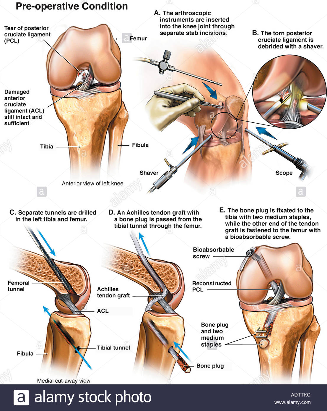 PCL ARTHROSCOPY.jpg