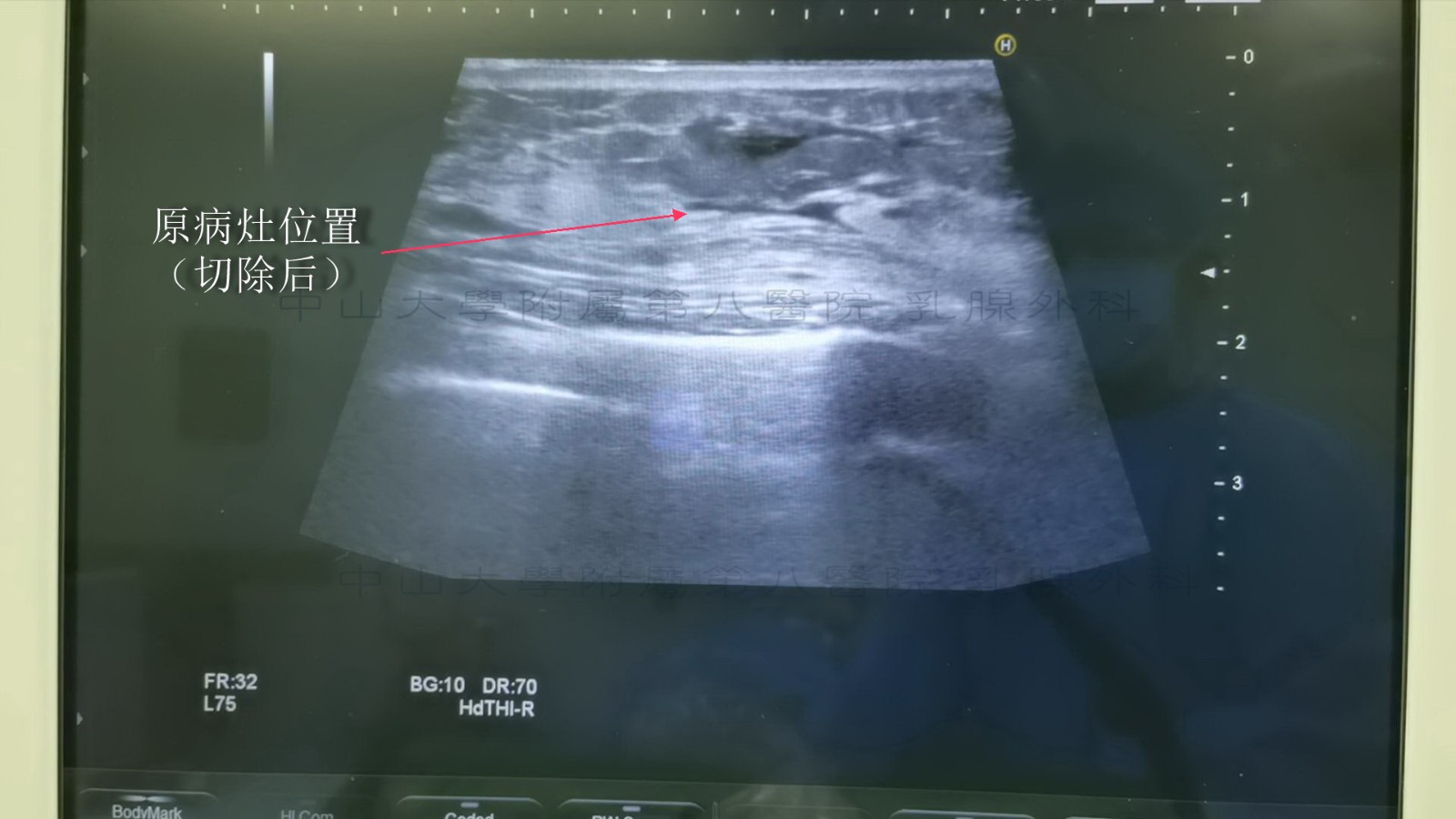 术后影像（文字）.jpg