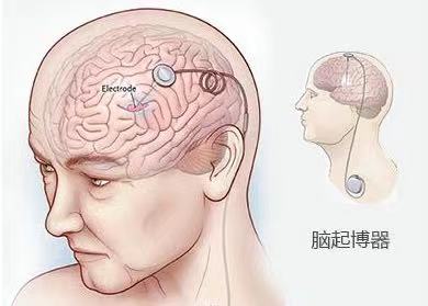答帕友问：都在说DBS手术效果好，但是风险有多大呢？