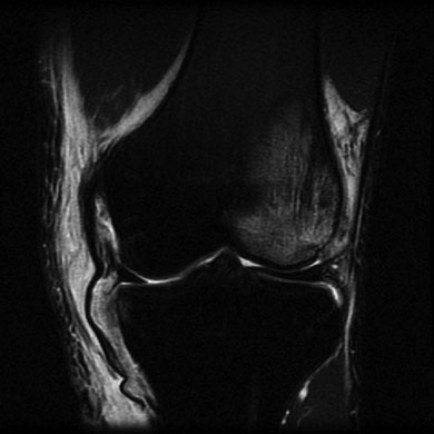 ACL+MCL.jpg