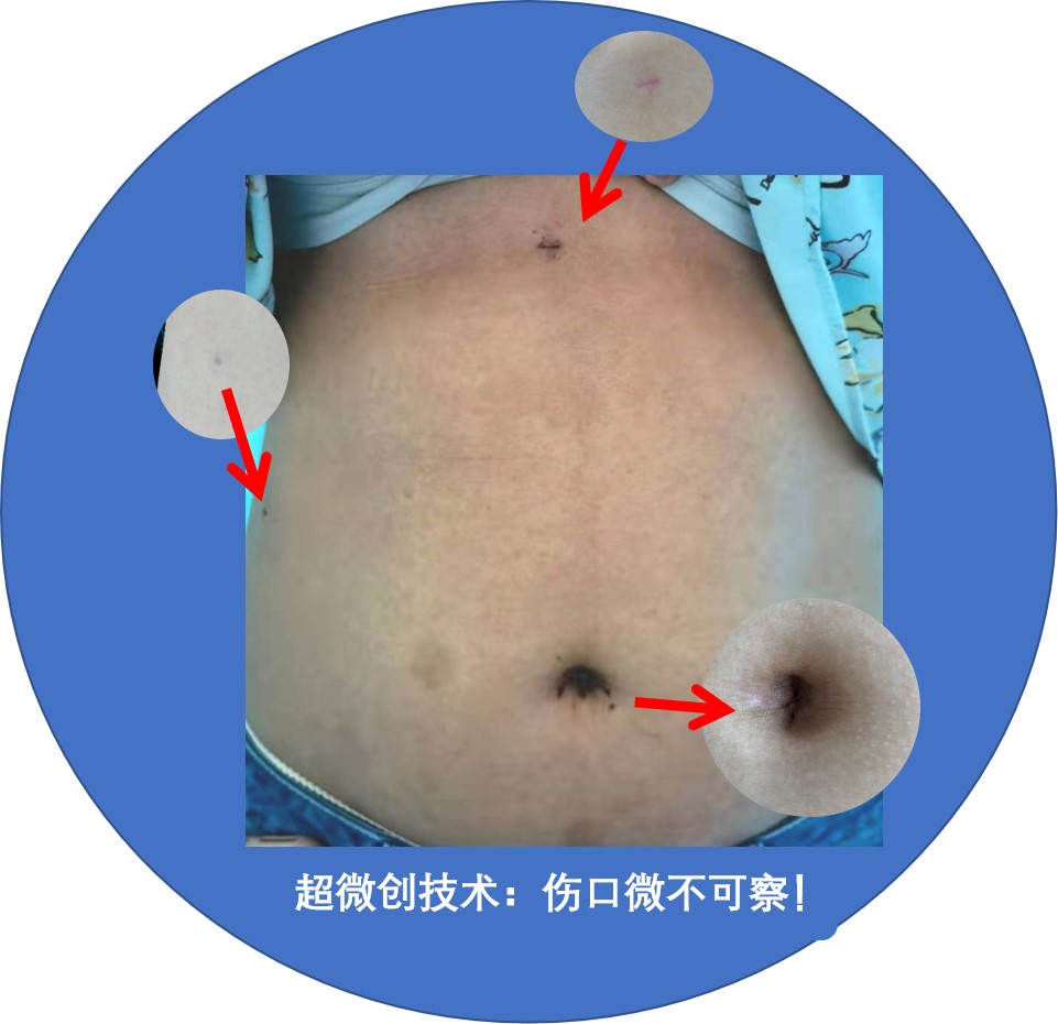 超微创腹腔镜术后.jpg