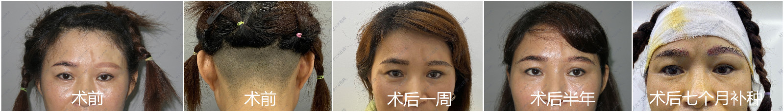 1627380094101038.jpg 术前_副本.jpg