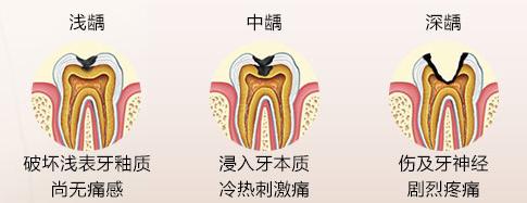 龋病的发展.jpg