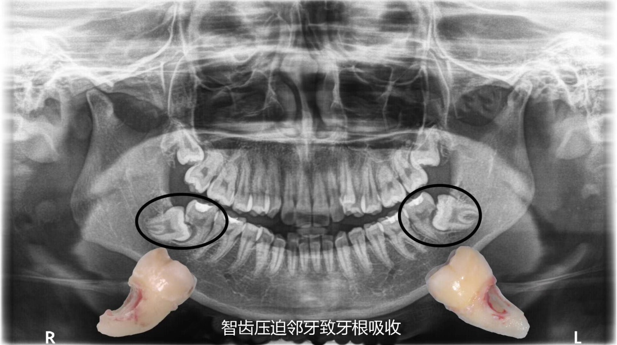 牙根吸收.png