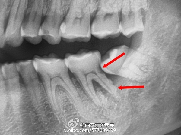 牙周性疾病.jpg