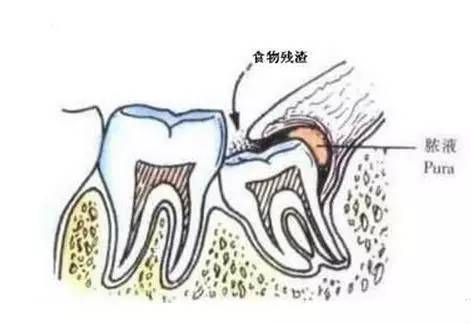 发炎2.jpg