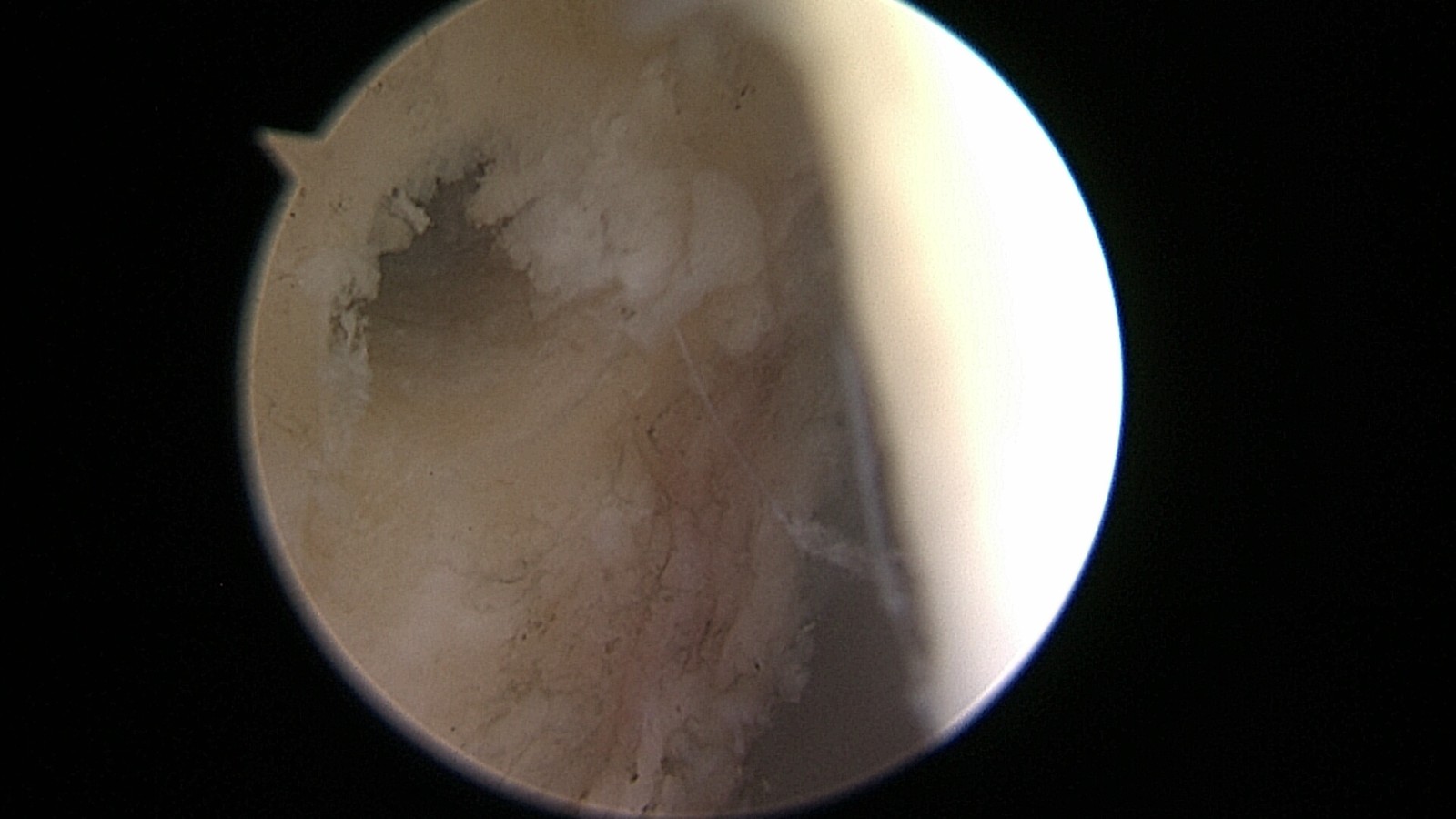 _蒋一玮_588492_KneeArthroscopy膝_2021-07-23-092242_尤田__Still_010(1).jpg