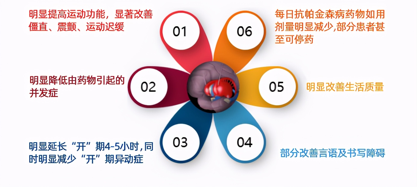 我拒绝了一台脑起搏器手术