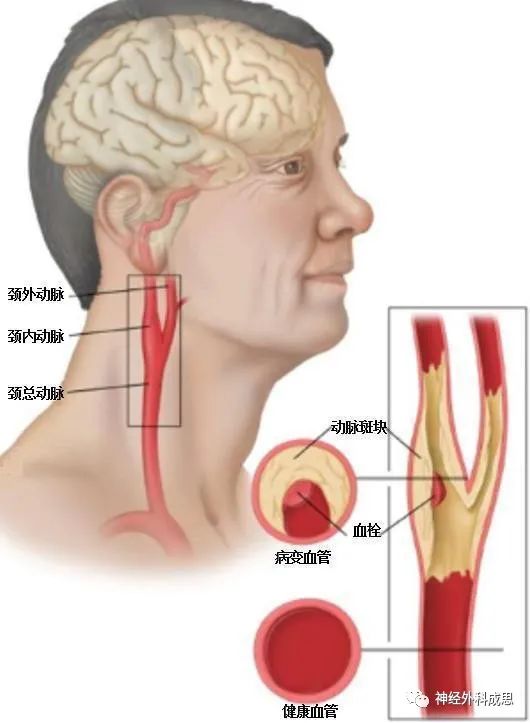 颈动脉狭窄篇动脉粥样硬化