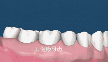 牙周炎发展.gif