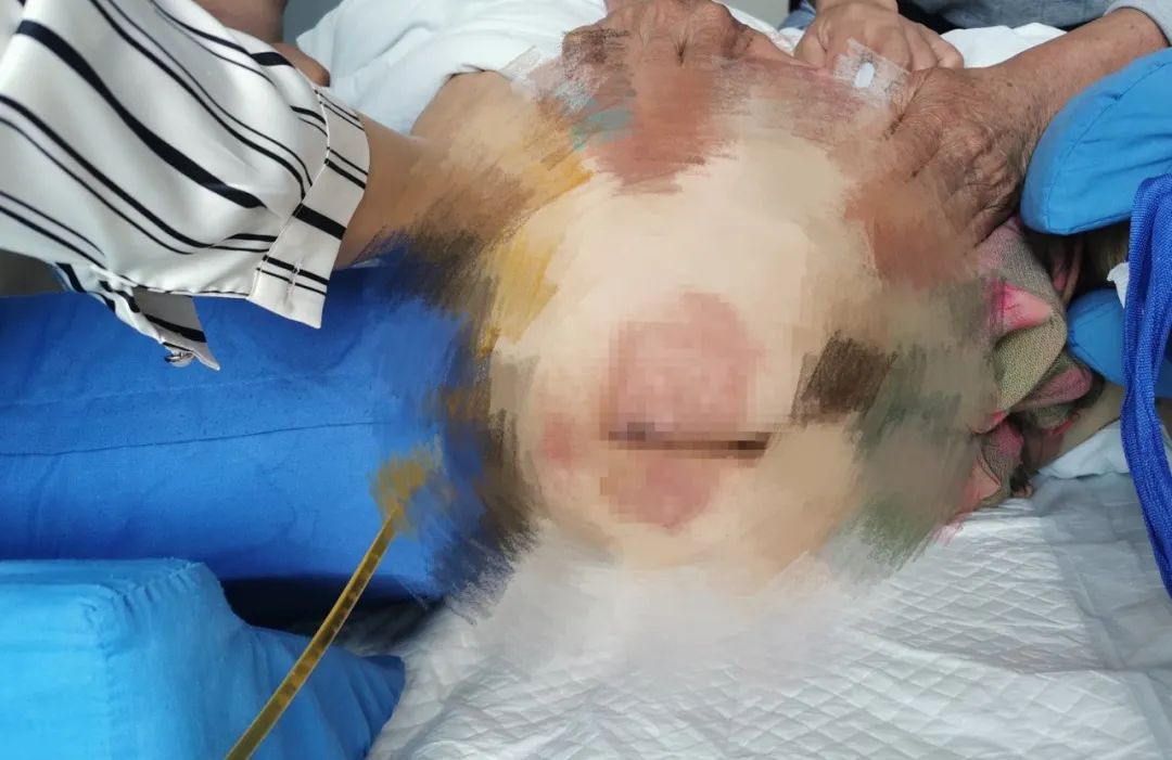 一场DBS手术终于让她重新站了起来