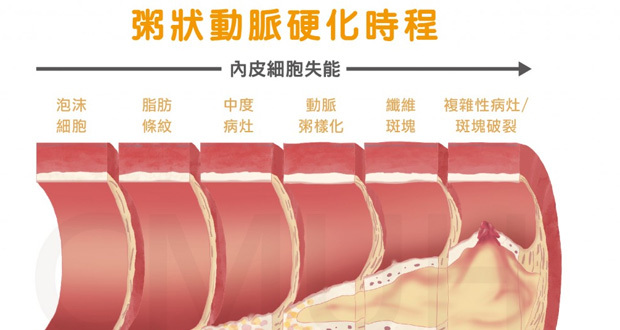 粥样硬化血管.jpg