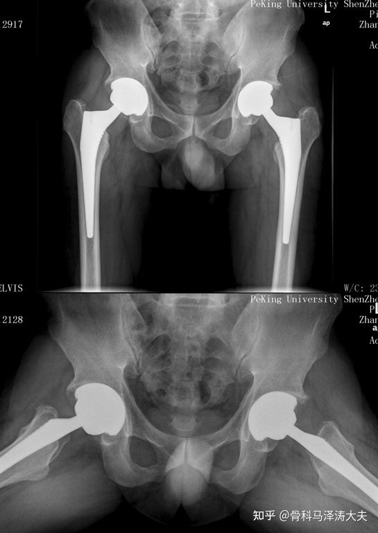 股骨头坏死人工髋关节置换术问答-健康160