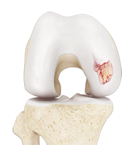 knee-arthritis.jpg