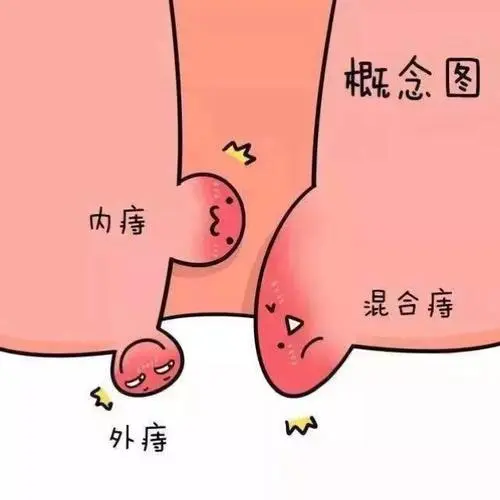 痔疮 (3).jpg