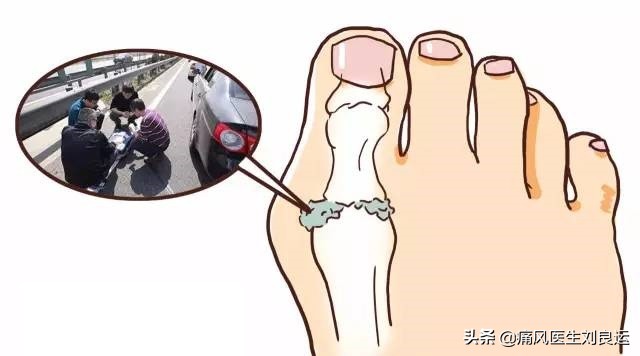 治疗痛风有三条路：给炎症绝路，给尿酸出路，给肾脏活路