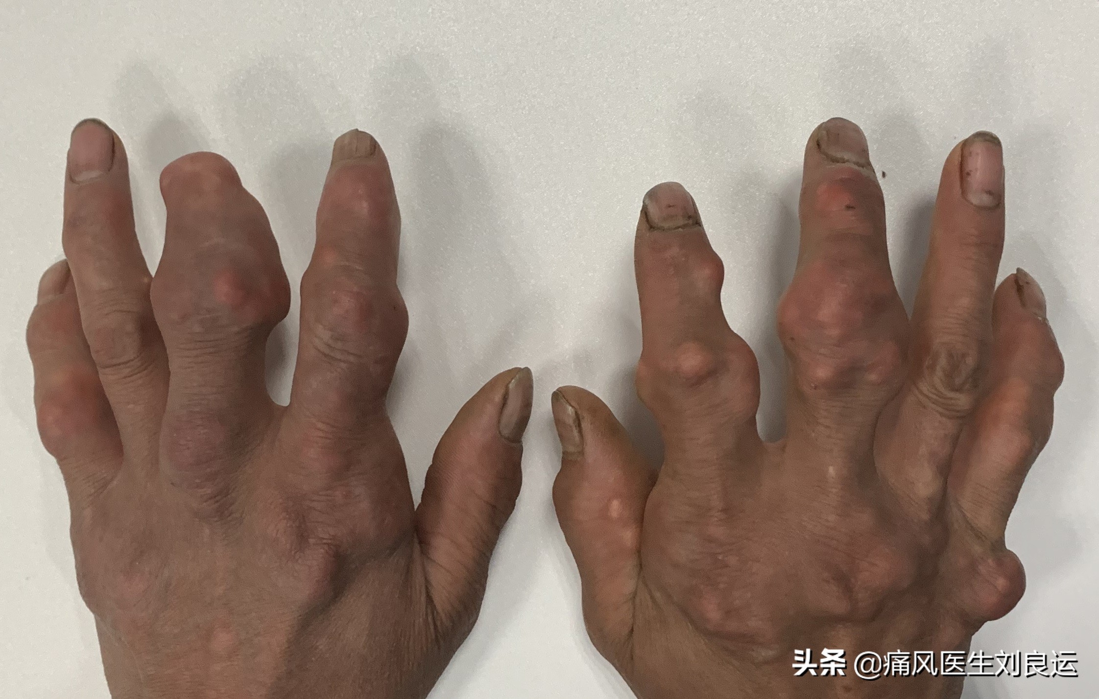 治疗痛风有三条路：给炎症绝路，给尿酸出路，给肾脏活路