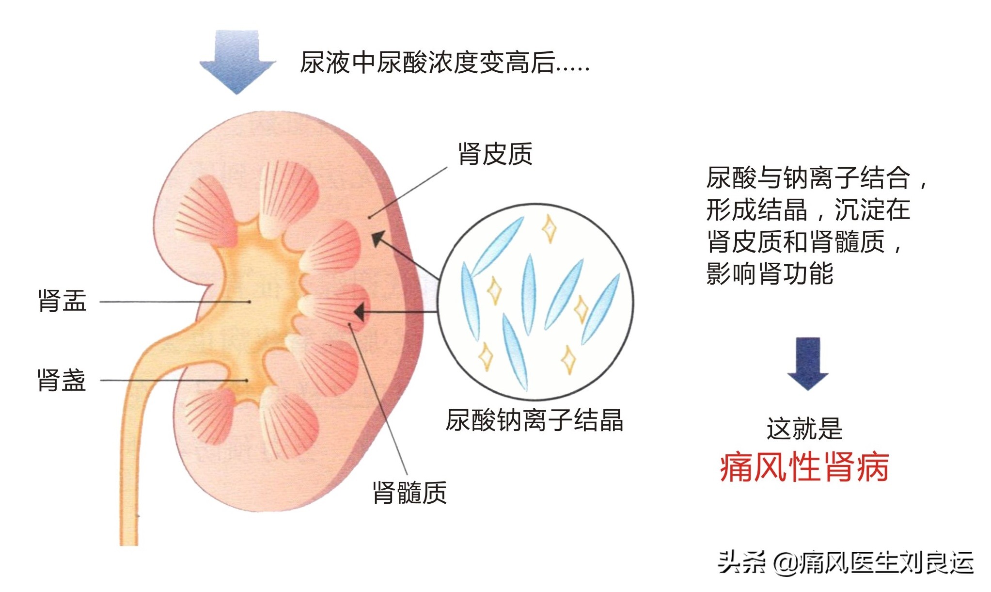 治疗痛风有三条路：给炎症绝路，给尿酸出路，给肾脏活路