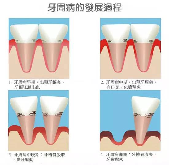 牙周发病过程.jpg