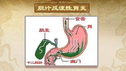 胆汁反流.jpg