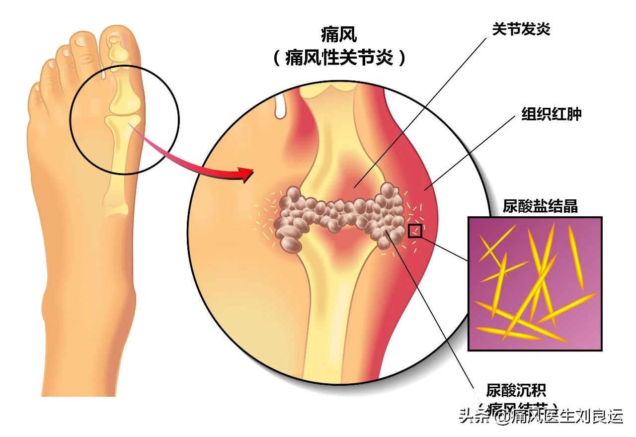 痛风时能用热敷减轻关节疼痛？医生辟谣，热敷不当可加剧疼痛