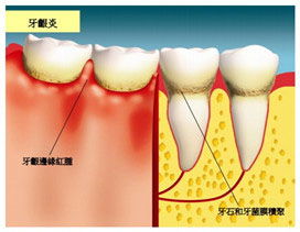 牙龈炎怎么治疗