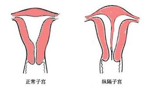 子宫偏大或者偏小会影响怀孕吗