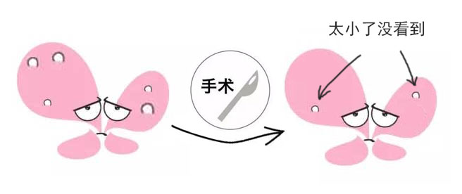 你的结节还在“观察”吗？谨慎进入误区