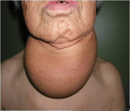 甲状腺结节钙化究竟是不是癌？