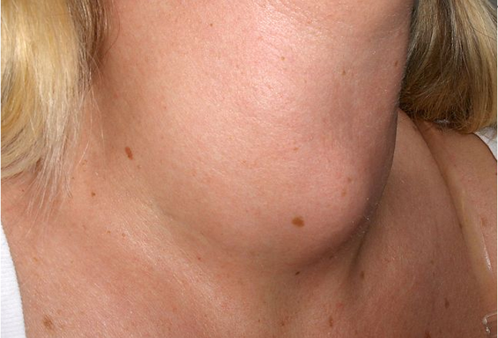 甲状腺结节钙化究竟是不是癌？