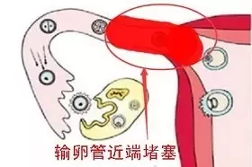 34岁输卵管梗阻1年，术后促排1次怀孕，输卵管通了就能怀孕？