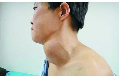 心慌手抖？甲亢在背后作怪