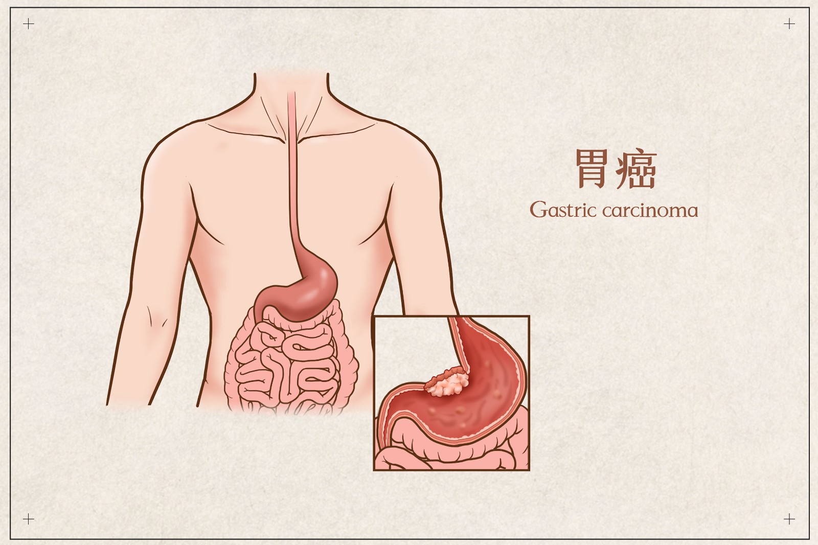 胃癌.jpg