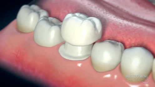 全瓷牙冠的制作过程,根管治疗后选择牙冠修复 