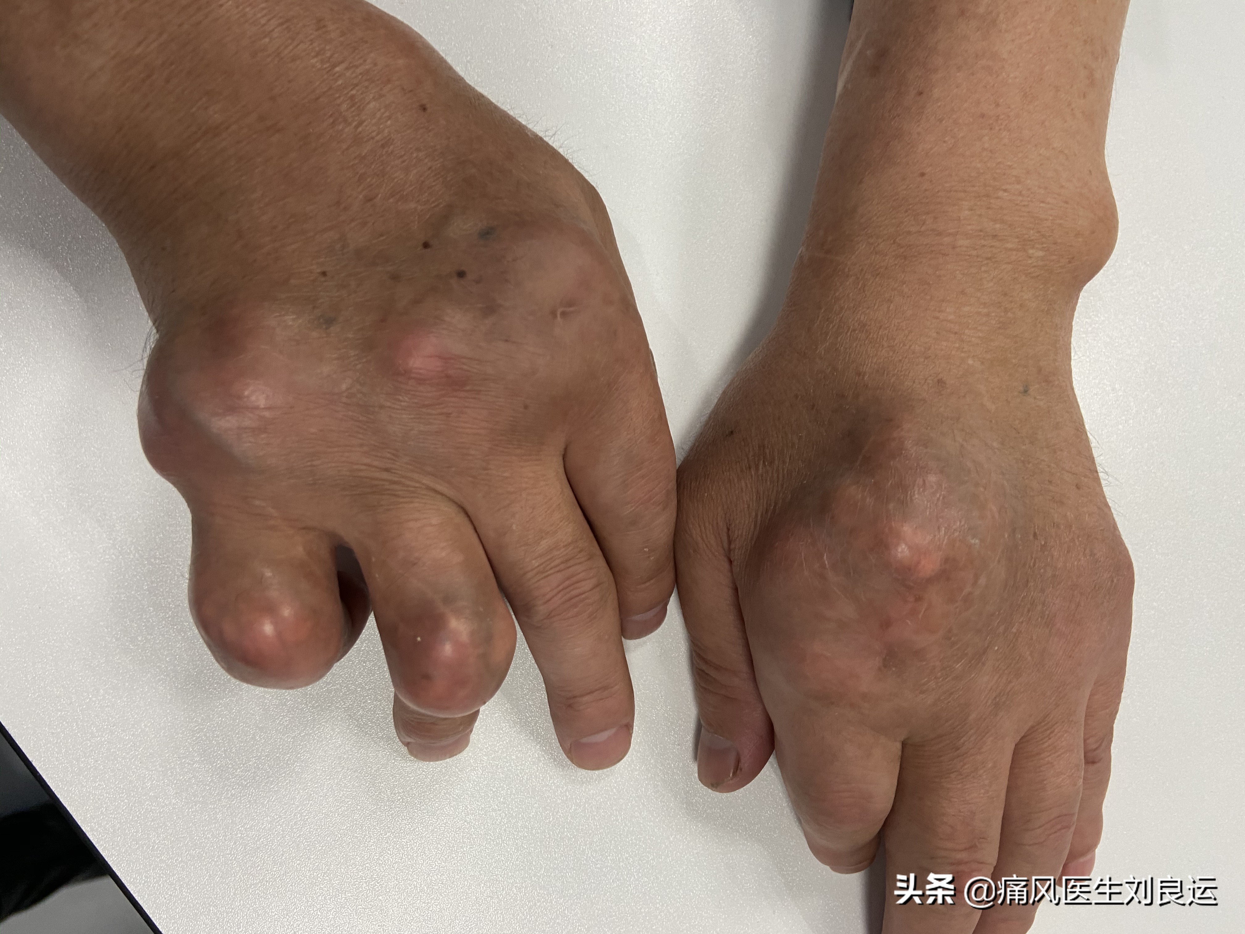 痛风发作时能忍则忍，实在痛到不能忍再吃止痛药？医生辟谣